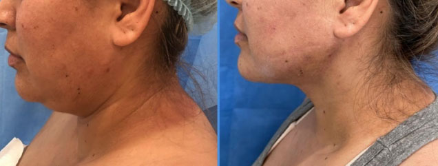 Liposuction of the Chin - Patient AA