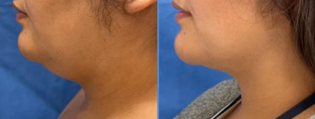 Liposuction of the Chin - Patient BB