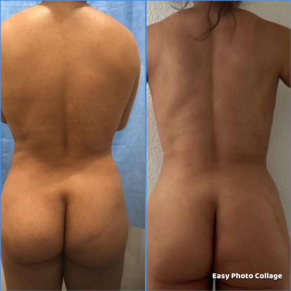 Liposuction of upper flanks - Patient CC