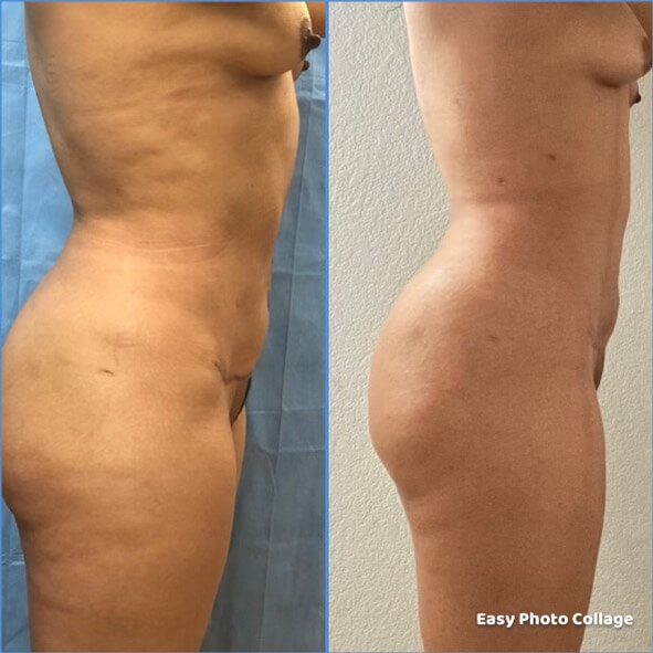 Liposuction abdomen, upper flanks & thighs - Patient DD