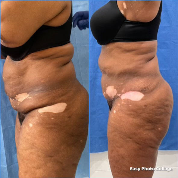 Tummy Tuck - Patient GGG