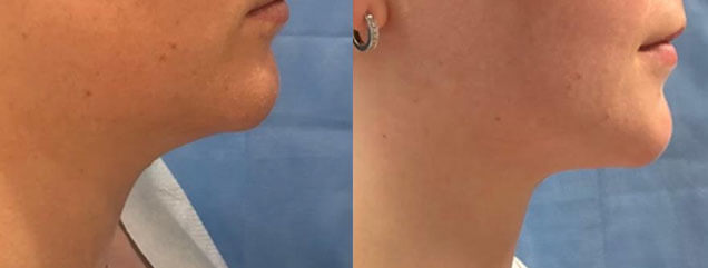 Liposuction of the Chin - Patient HH