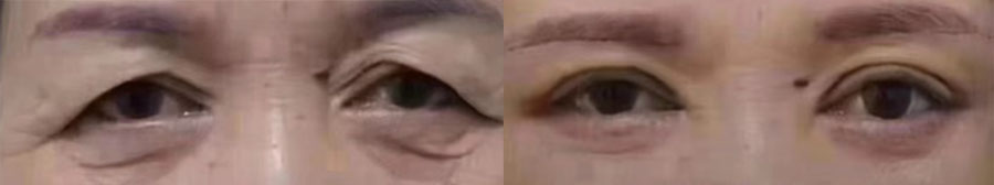 Blepharoplasty (2-weeks post-op) - Patient KK