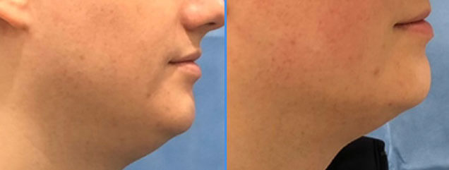 Liposuction of the Chin - Patient LL