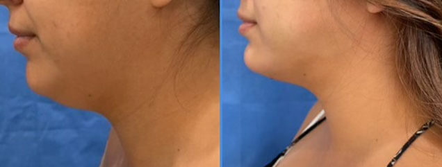 Liposuction of the Chin - Patient NN