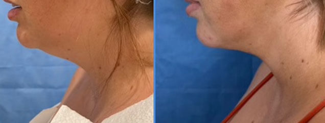 Liposuction of the Chin - Patient OO