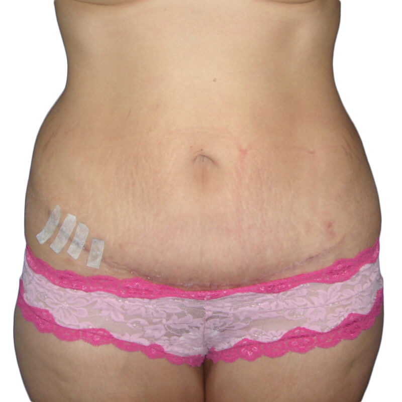 Tummy Tuck Patient After