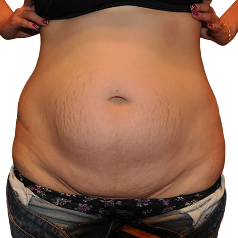 Tummy Tuck Patient Before